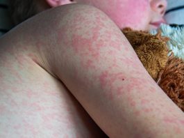 Measles cases reach 33-year high as RFK Jr. pursues anti-vaccine agenda