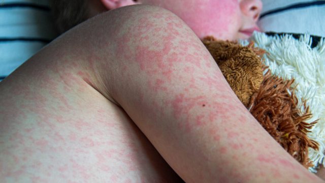 Measles-cases-reach-33-year-high-as-RFK-Jr-pursues-anti-vaccine.jpg Measles cases reach 33-year high as RFK Jr. pursues anti-vaccine agenda